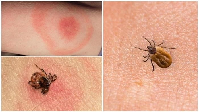 Способы лечения и профилактика укусов клопов и комаров