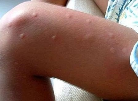 Лечение аллергии на укусы