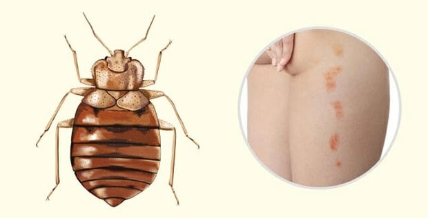 Симптомы и признаки укусов насекомых