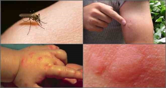 Признаки укуса мухи: как их распознать