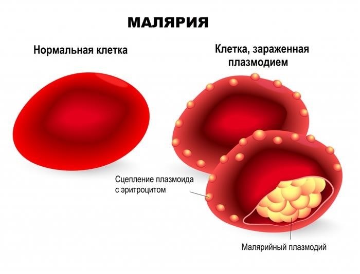 Как проявляется малярия?