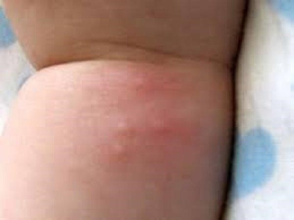 Как снизить боль от укусов блох у ребенка