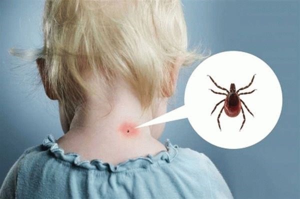 В чем разница между укусами комара, клопа и клеща?